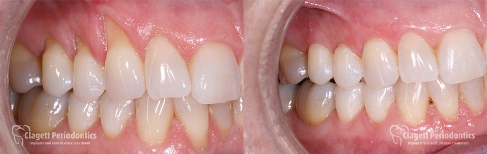 Gum Recession Patient 1 Teeth
